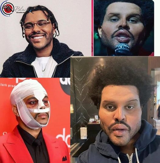 The Weeknd mostra rosto real após ‘cirurgia plástica’ chocado