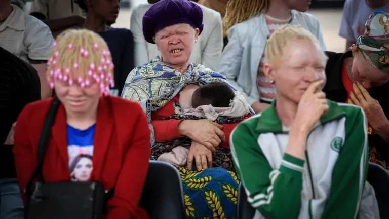 Cancro da pele faz vítimas entre albinos em Angola por falta de apoios